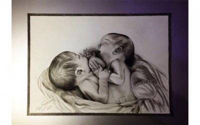 Syria: Conjoined twins die