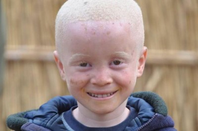  Tanzania: Attacks on persons with albinism decline; local attitudes must change, UN expert finds   