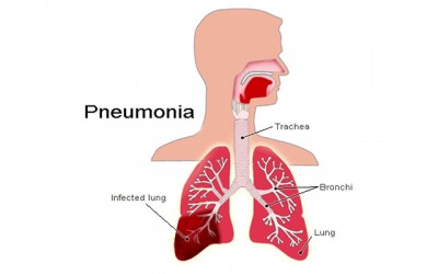  This World Pneumonia Day, the Indian Academy of Pediatrics calls for â€œNo More Pneumoniaâ€