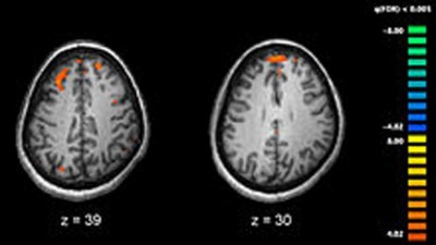 Schizophrenia originates early in pregnancy, â€œmini-brainâ€, research suggests