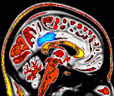 'Mindful people' feel less pain; MRI imaging pinpoints supporting brain activity