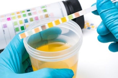 Simple urine test could significantly improve detection of adrenal cancer: Study