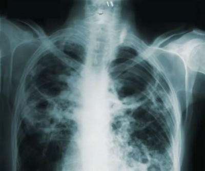 Shocking WHO report: TB killed 1.2 million people in 2024