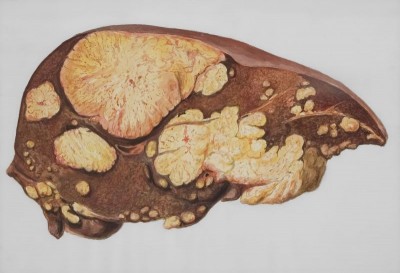 Care Health data reveals shocking spike in Liver disease across India